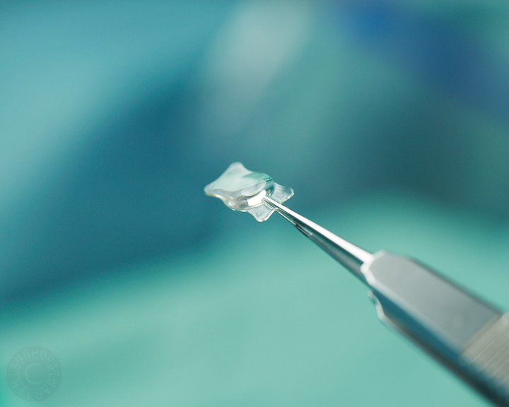 Eine chirurgische Pinzette hält eine feine, transparente Intraokularlinse für eine Augenoperation vor einem türkis-blauen Hintergrund.