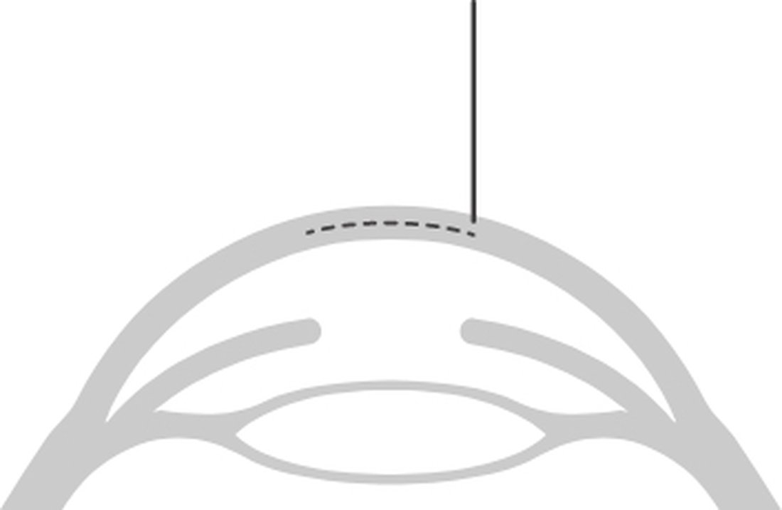 Eine minimalistische Querschnittzeichnung des vorderen Augenabschnitts zeigt die Hornhaut, die Iris und die Linse sowie eine gestrichelte Linie, die eine geplante Inzision oder Laserbehandlung markiert.